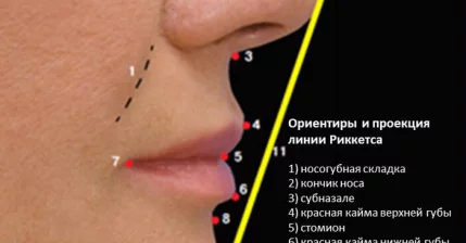 Биоревитализация губ